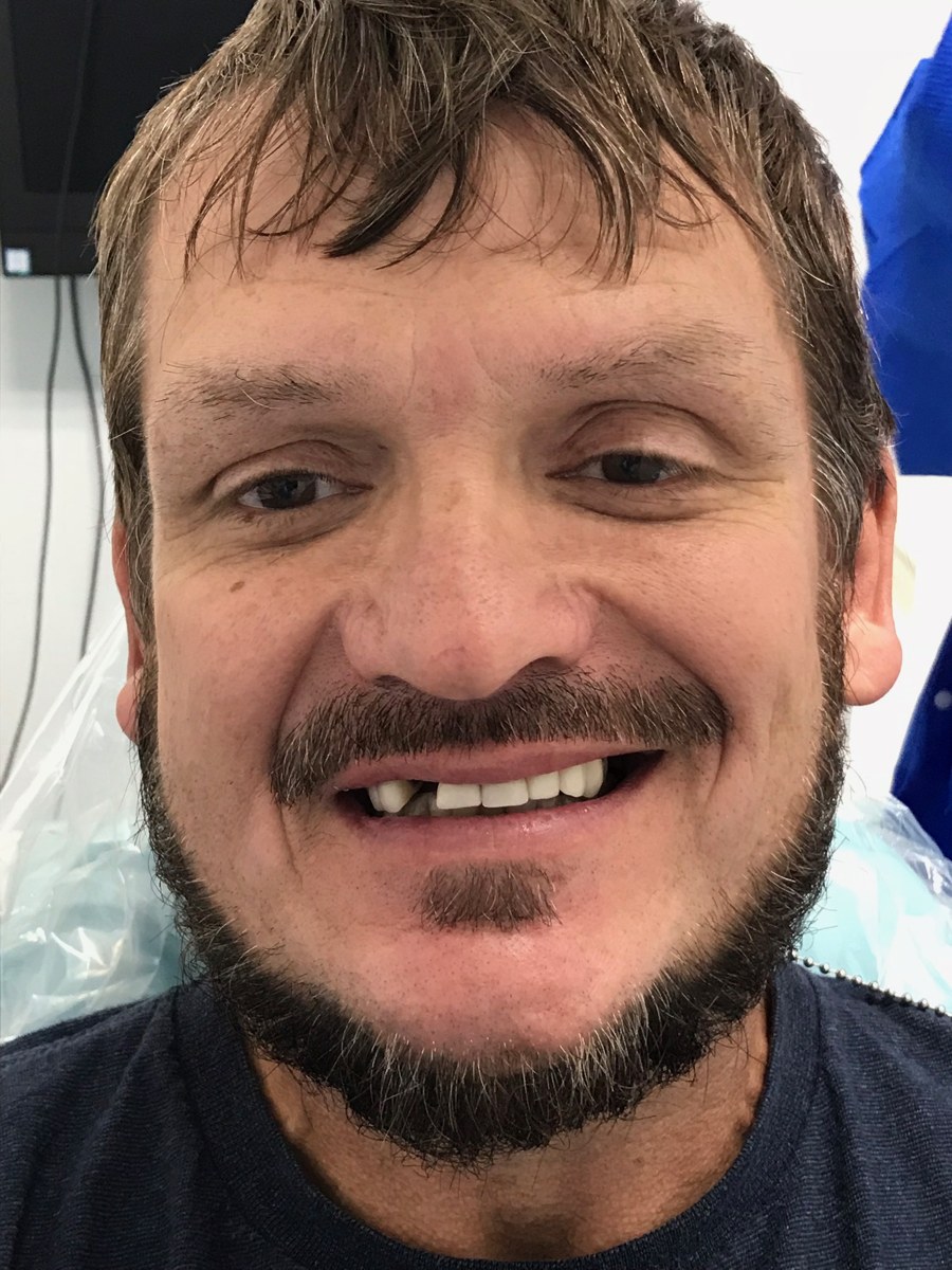 Patient before All-on-4 — missing and broken front teeth